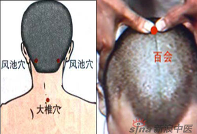 常見病艾灸時(shí)怎樣選穴？--大椎百會(huì)穴